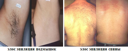 ЭЛОС эпиляция – избавьтесь от волос