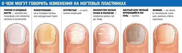Онихомикоз. Грибок ногтей